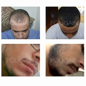 صور قبل وبعد تقارن تغطية الشعر عند خط الشعر والخد