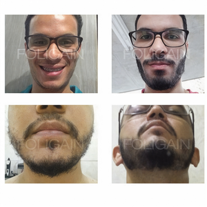 صور قبل وبعد تقارن تغطية اللحية من الأمام ومن أسفل الذقن